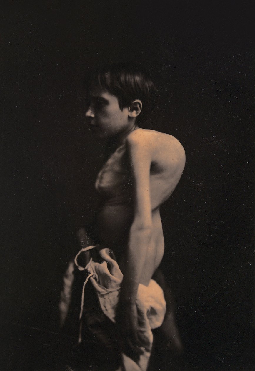 Portræt af en pukkelrygget dreng, ca. 1855-57 af Guillaume Benjamin Armand Duchenne de Boulogne