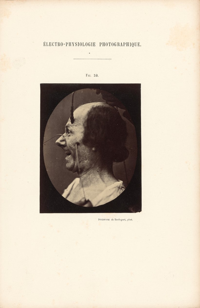 Fotografisk elektrofysiologi, figur 39 af Guillaume Benjamin Duchenne