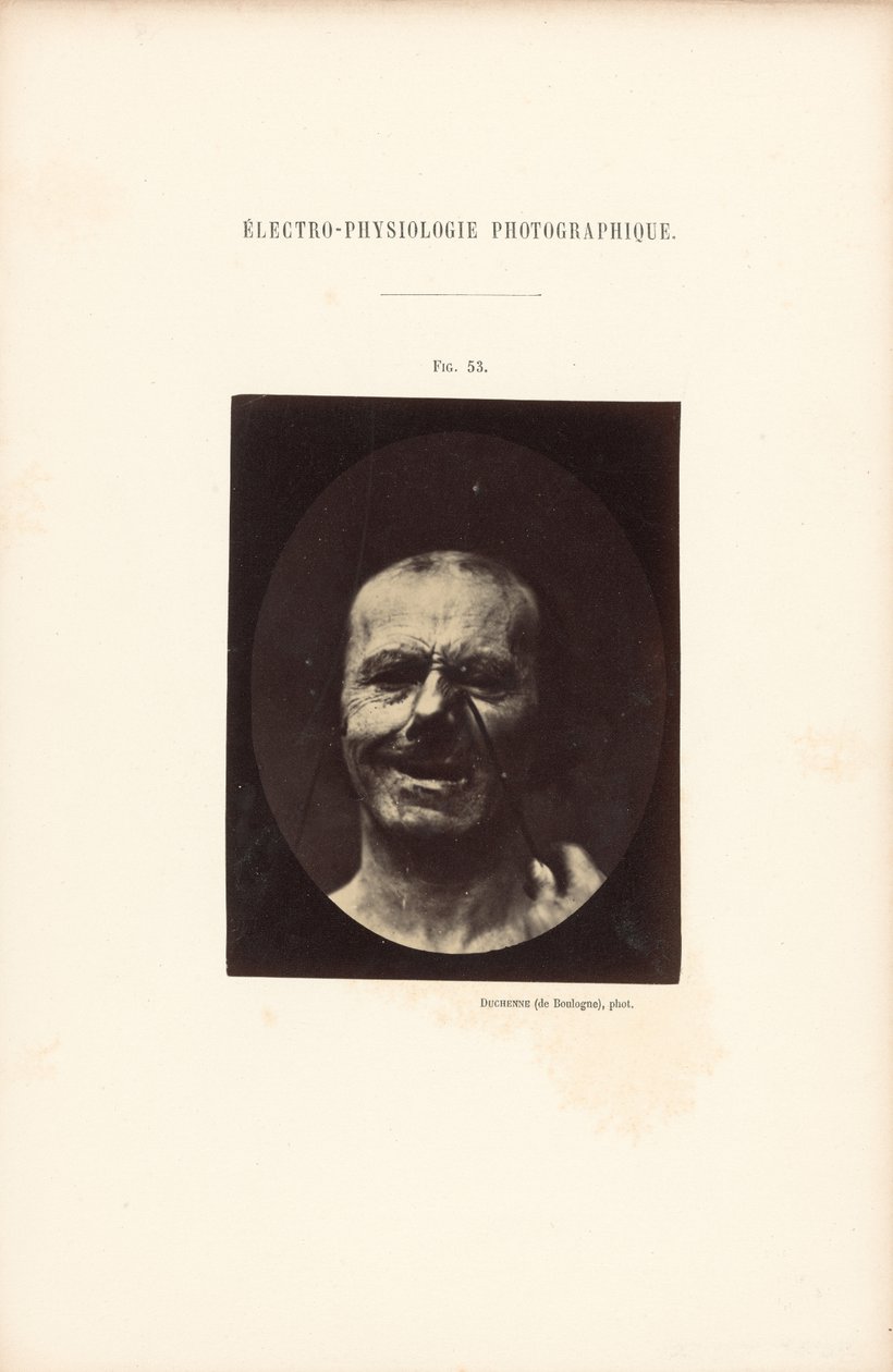Fotografisk elektrofysiologi, figur 53 af Guillaume Benjamin Duchenne