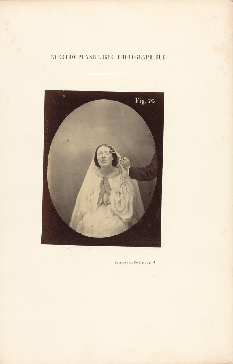 Fotografisk elektrofysiologi, figur 76 af Guillaume Benjamin Duchenne