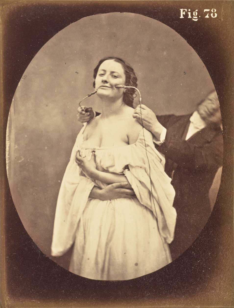 Fig. 78 af Guillaume Benjamin Duchenne