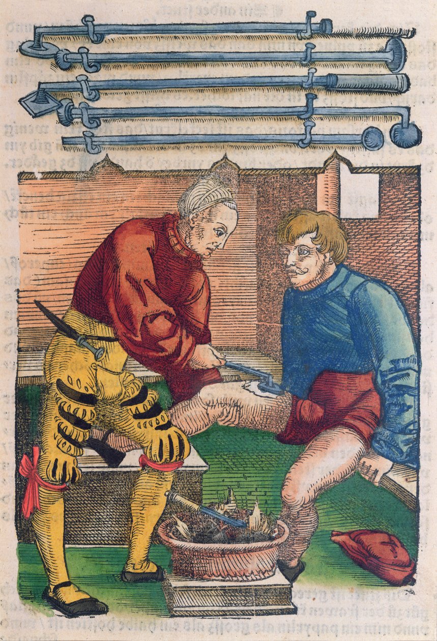 Cauterisation, illustration fra 