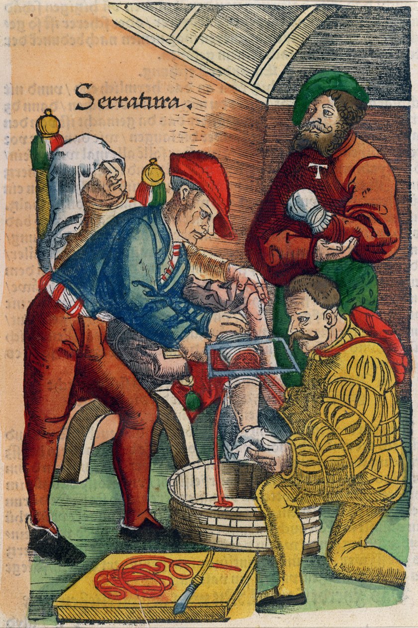 En amputation, illustration fra 