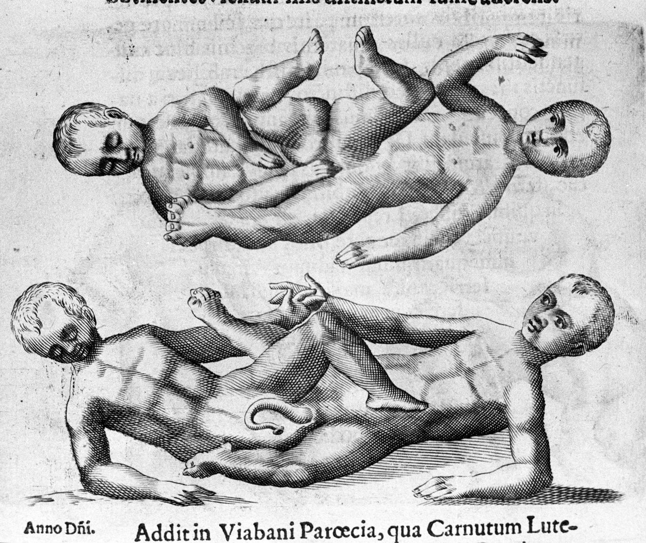 Forskellige typer menneskelige monstre: Siamesiske børn forbundet med bækkenet. Indgravering fra "Monstrenes natur, årsager og forskelle" af Fortunio Liceti (1577-1656), italiensk videnskabsmand. 1646 af Italian School