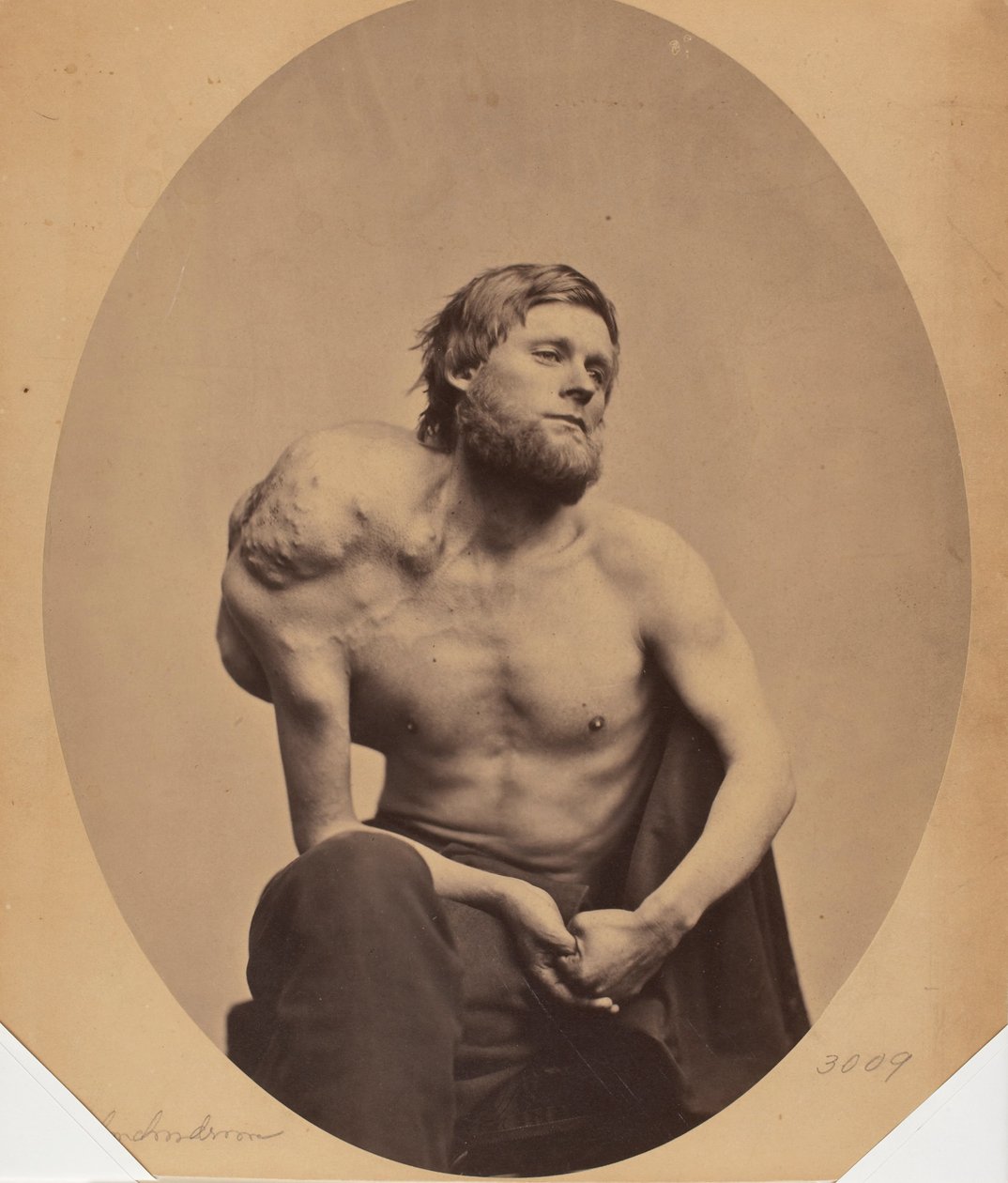 Enchondroma af scapula af James Wallace Black