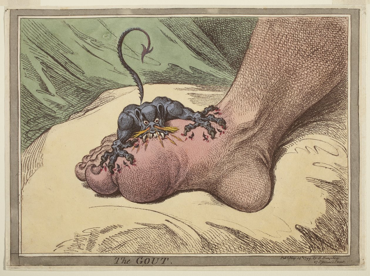 Gigten af James Gillray