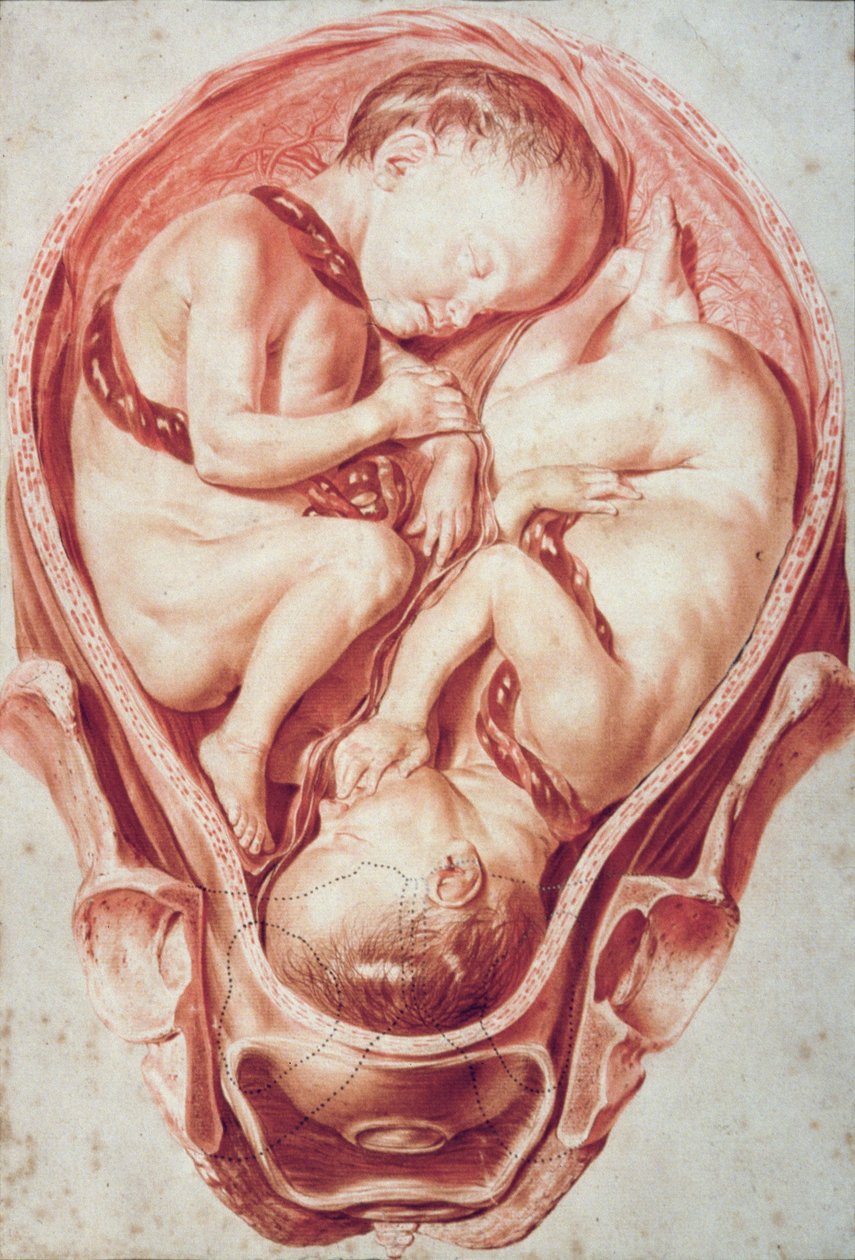 Ms Hunter 654 Plade 10 Tegning fra et sæt obstetriske tegninger til William Smellies (1697-1763) 