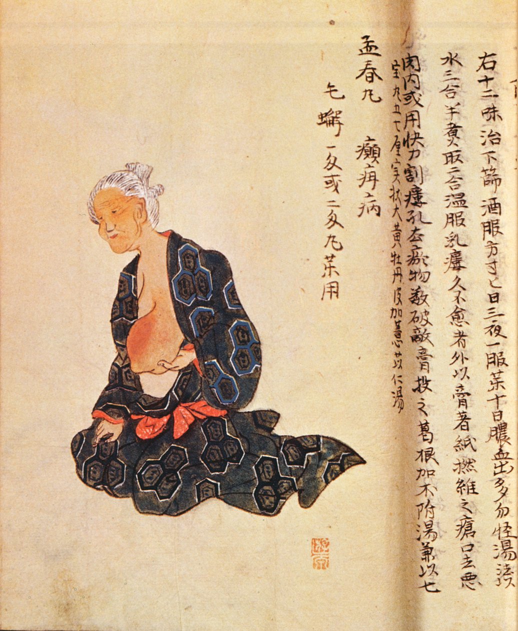 Den første kirurgiske behandling af brystkræft udført under generel anæstesi af Seishu Hanaoka (1760-1836) i 1804 af Japanese School