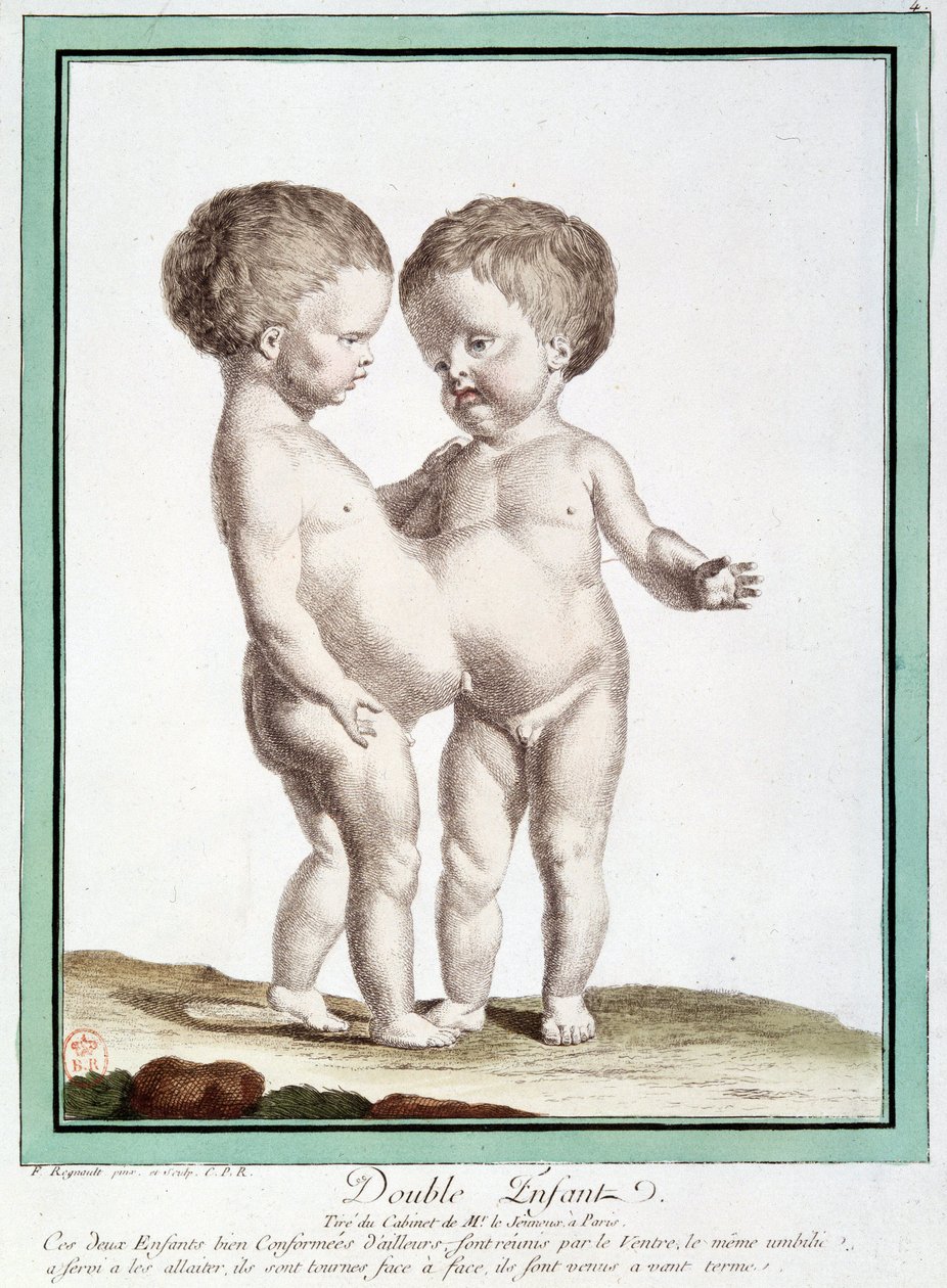 Siamesiske børn - i "" Naturens afvigelser"" af Régnault af Jean Baptiste Regnault