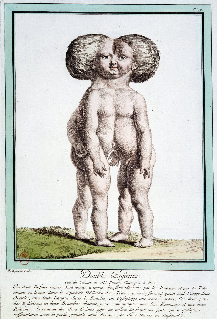 Siamesiske børn - i "" Naturens afvigelser"" af Régnault af Jean Baptiste Regnault