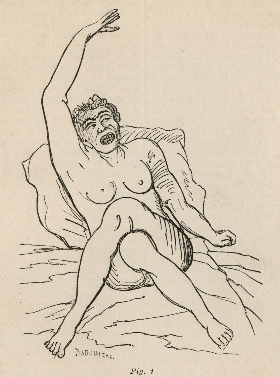 Hysterisk epilepsi, anfald, forvridninger, fig. 1 fra 