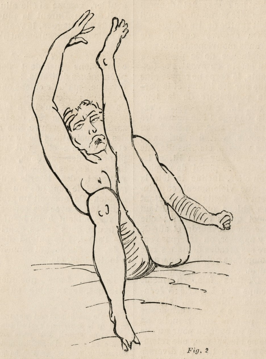 Hysterisk epilepsi, anfald, forvridninger, fig. 2 fra 