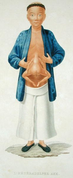 Kinesisk mand med en uudviklet sammenføjet tvilling knyttet til maven, illustration fra en fransk rejsebog, indgraveret af M. Legrand (farvet gravering) af Jean Gabriel (after) Pretre
