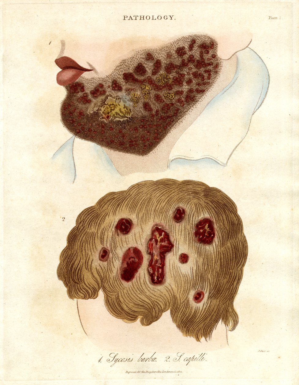 Patologisk illustration af Sycosis barbae og Sycosis capilli af John Pass