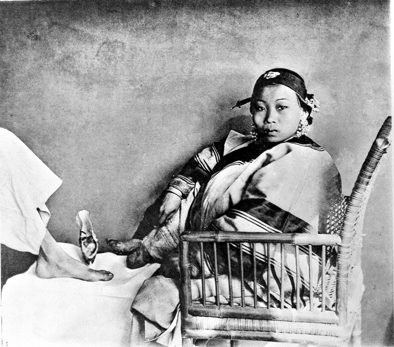 Kvinde viser sin fod lemlæstet ved at bære traditionelle sko ved siden af en europæisk fod (foto) af John Thomson
