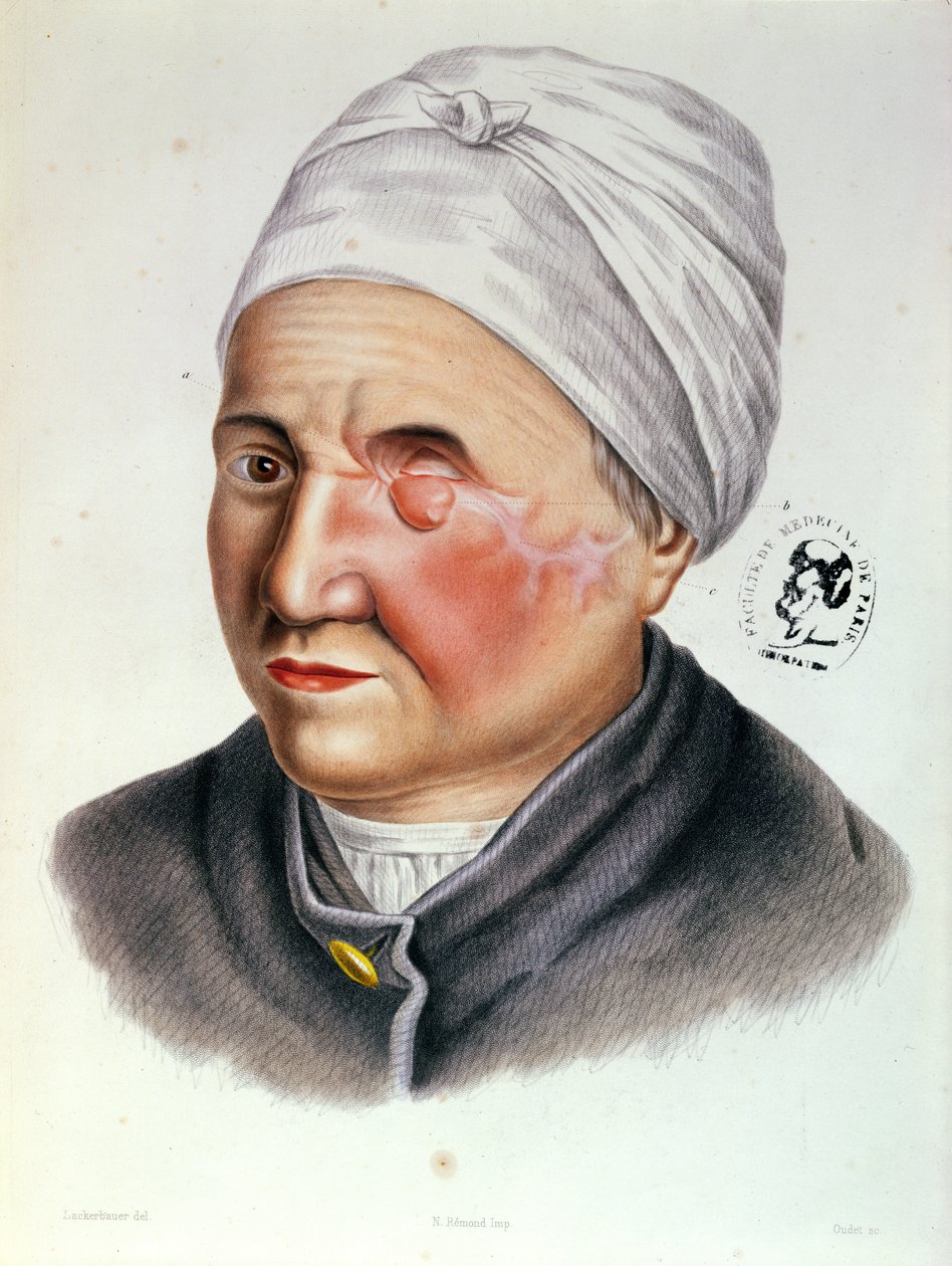 Illustration fra Traite de Chirurgie Plastique af Antoine Jobert de Lamballe (1799-1867) Paris, 1849 af Lackerbauer