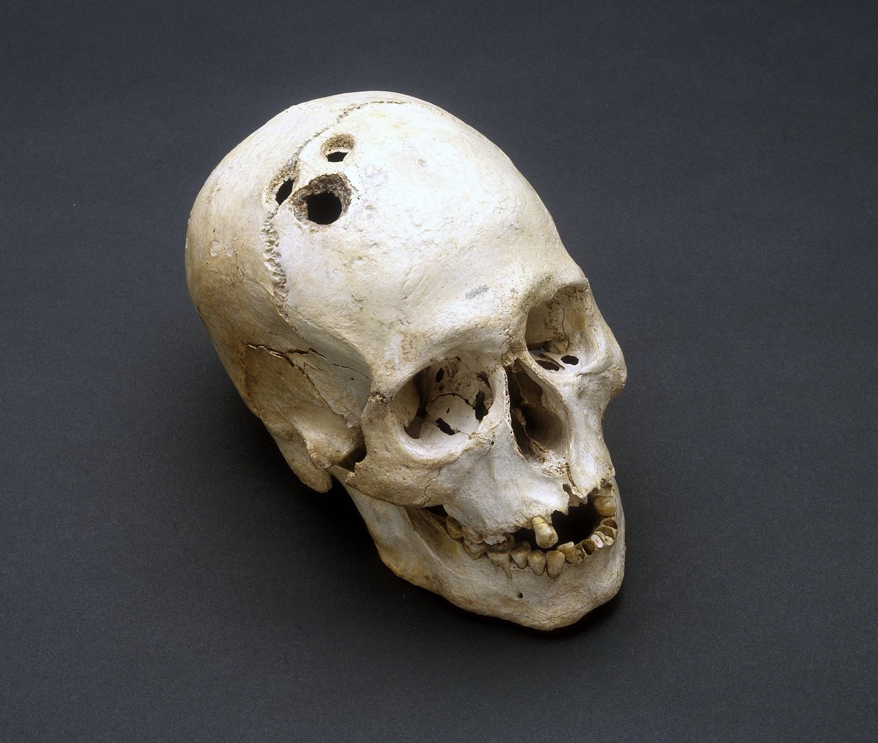 Trephination bronzealder kranie, Jeriko, Palæstina, 2200-2000 f.Kr. af Unbekannt Unbekannt