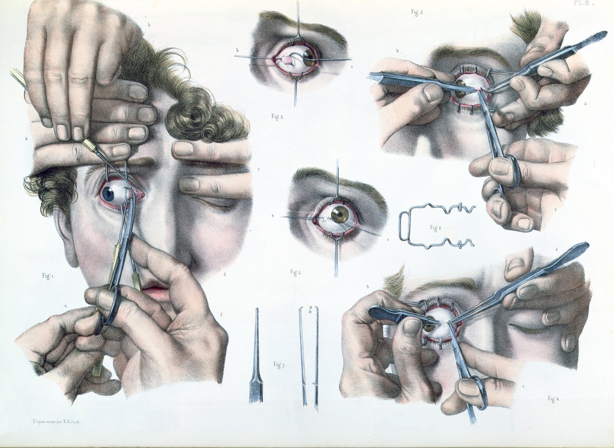 Operation af en strabismus, plade fra "Traite Complet de l