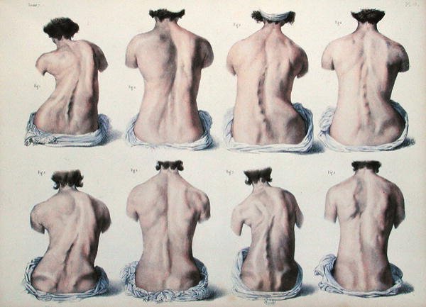 Spinal deformiteter, plade fra 