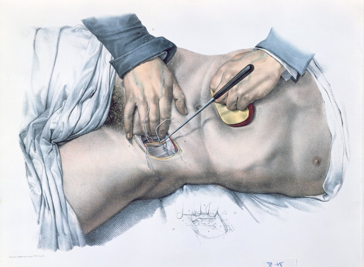 Binding af en arterie, tallerken fra 