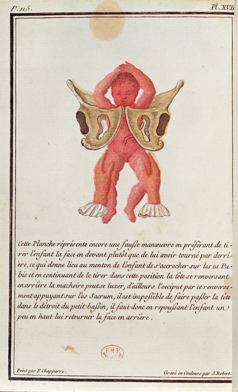 Tværsnit af et barn, der trækkes ud af livmoderen i benene, fra en bog af Madame Angelique Le Boursier du Coudray (1714-94), graveret af J. Robert, 1783 af P. Chapparre