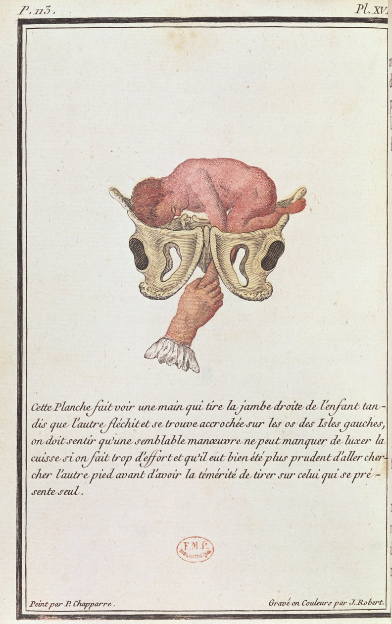 Tværsnit af et barn, der trækkes ud af livmoderen med armen, fra en bog af Madame Angelique Le Boursier du Coudray (1714-94), graveret af J. Robert, 1783 af P. Chapparre
