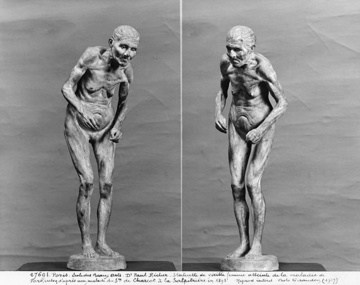 Statuette af en gammel kvinde med Parkinsons sygdom, efter 1895 (gips) af Paul Marie Louis Pierre Richer