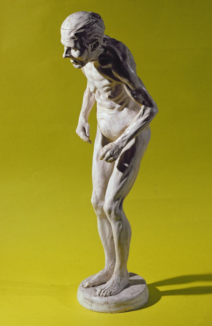 Figur af en kvinde med Parkinsons sygdom (gips) af Paul Marie Louis Pierre Richer