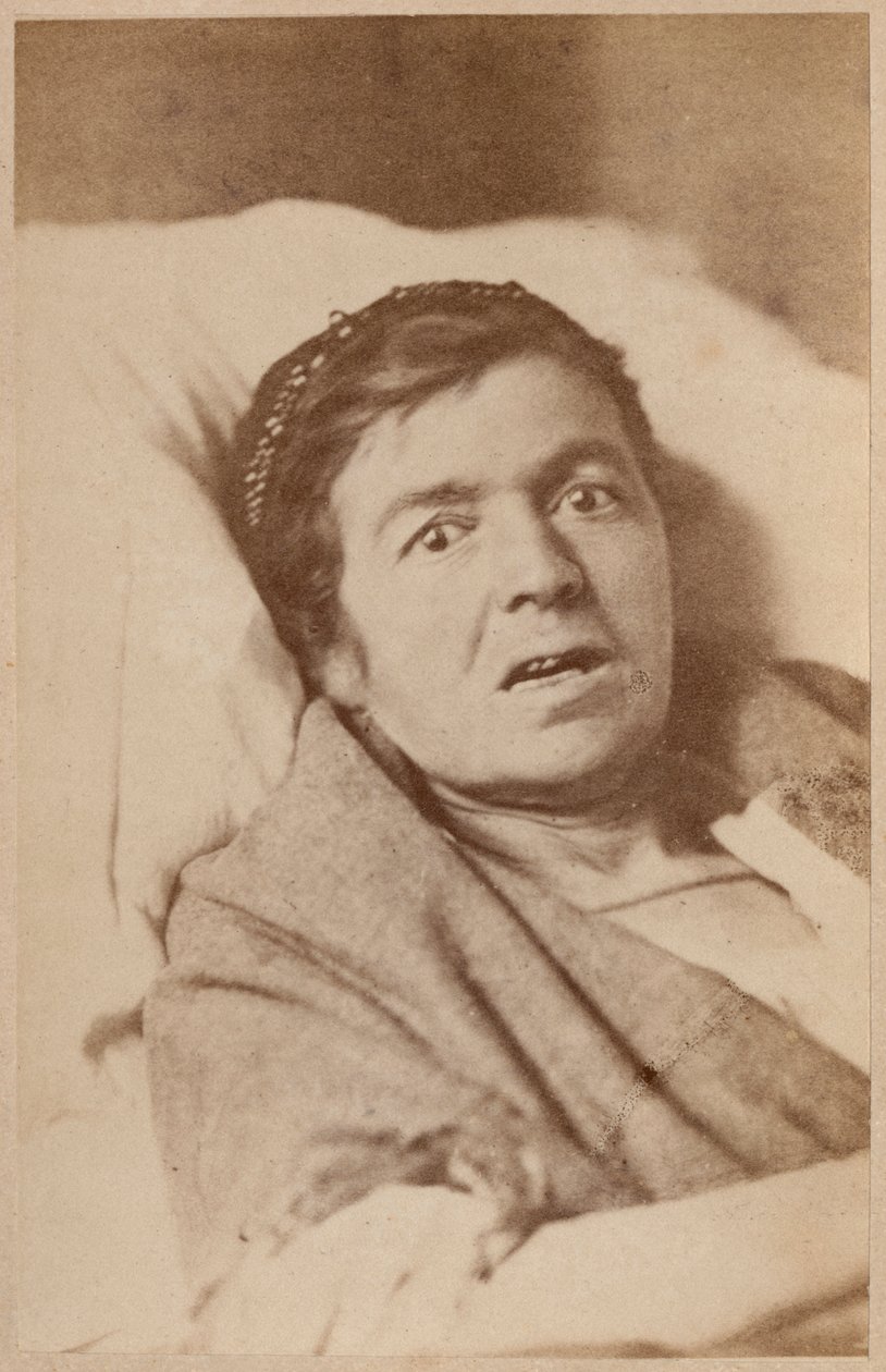 Hysterisk epilepsi, ansigtssammentrækning, plade VIII fra 