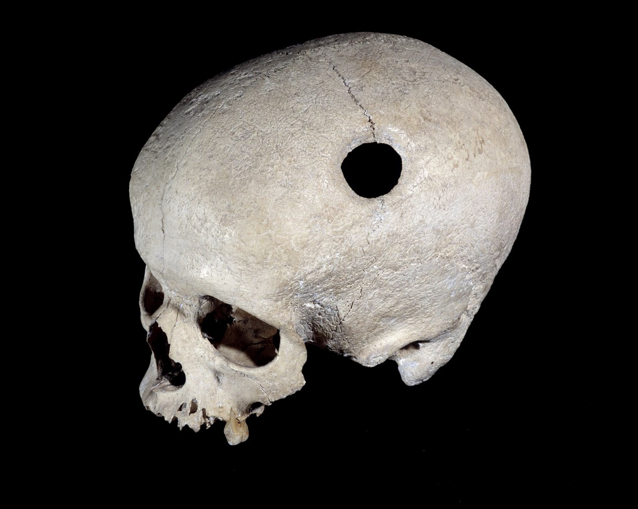 Forhistorisk kranie med trepanationsspor, Museum of National Antiquities. af Prehistoric Prehistoric
