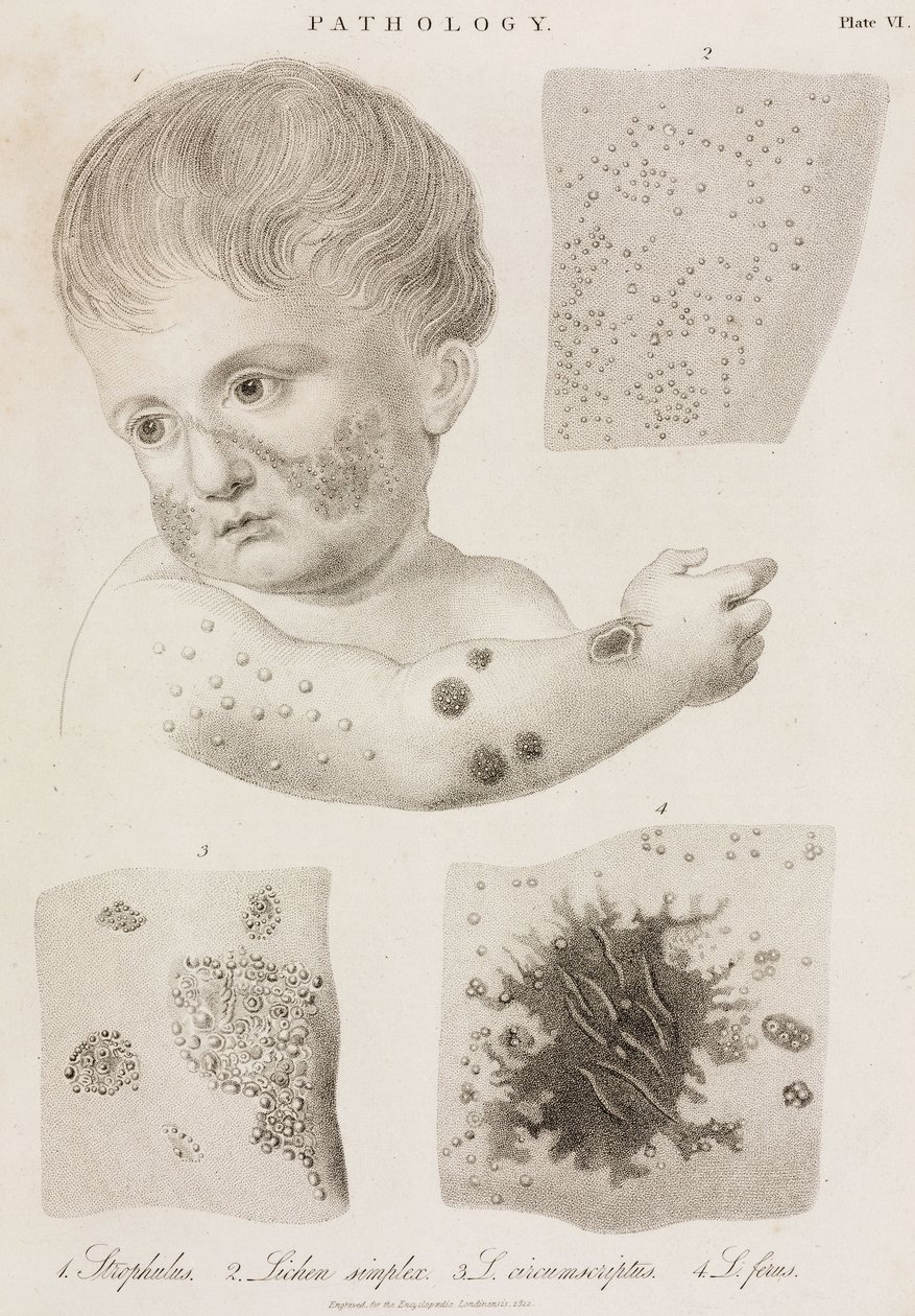 Dermatologi Typer af hudsygdomme af John Pardon