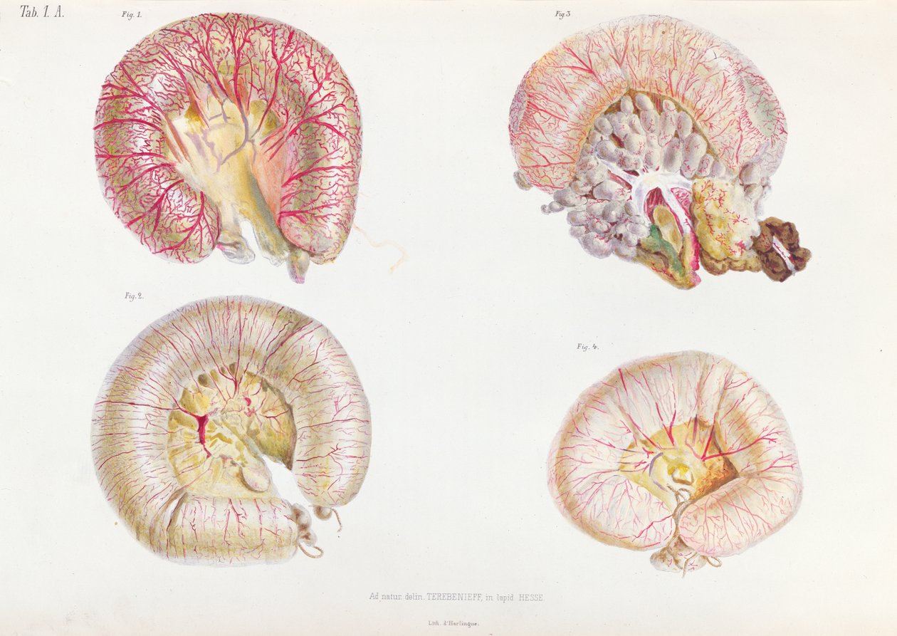 Den ydre overflade af tarmene inficeret med kolera, fra Anatomie Pathologique du Cholera Morbus, af Nikolai Ivanovich Pirogov (1810-81) udgivet i St. Petersborg, 1849 af Russian School
