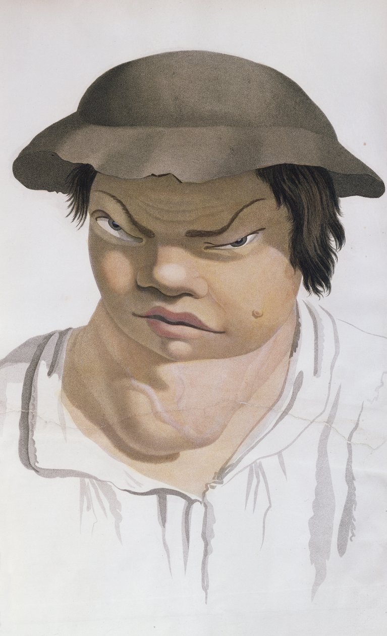 Endemic Scrofula, illustration fra en bog af Baron Jean Louis Alibert (1768-1837) af Salvadore Tresca