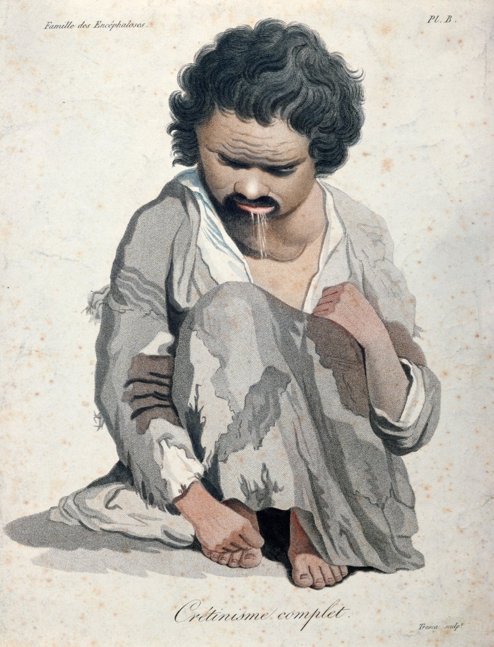Total kretinisme, fra en bog af Baron Jean Louis Alibert (1768-1837) af Salvadore Tresca