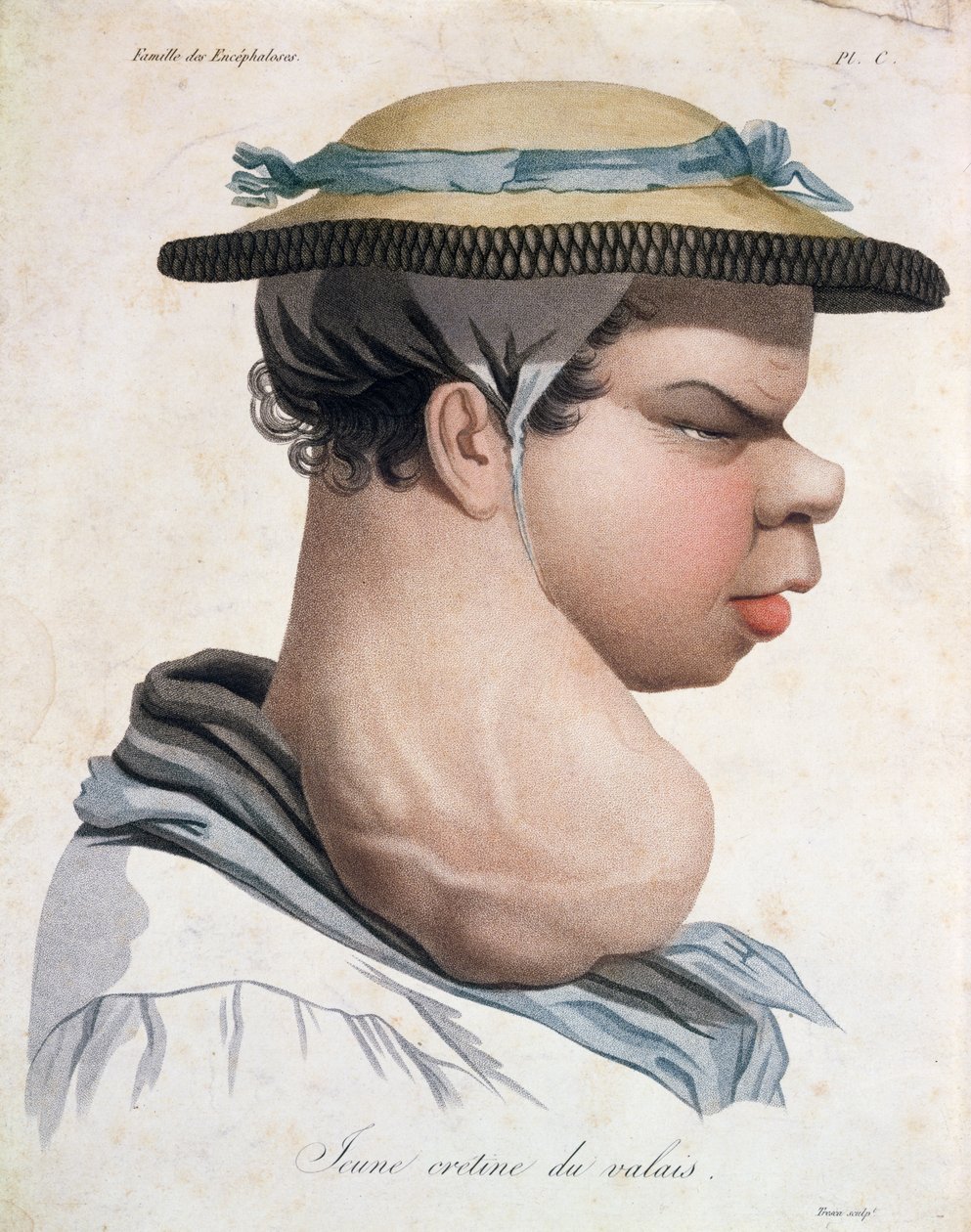 Young Cretin fra Valais, illustration fra en bog af Baron Jean Louis Alibert (1768-1837) af Salvadore Tresca
