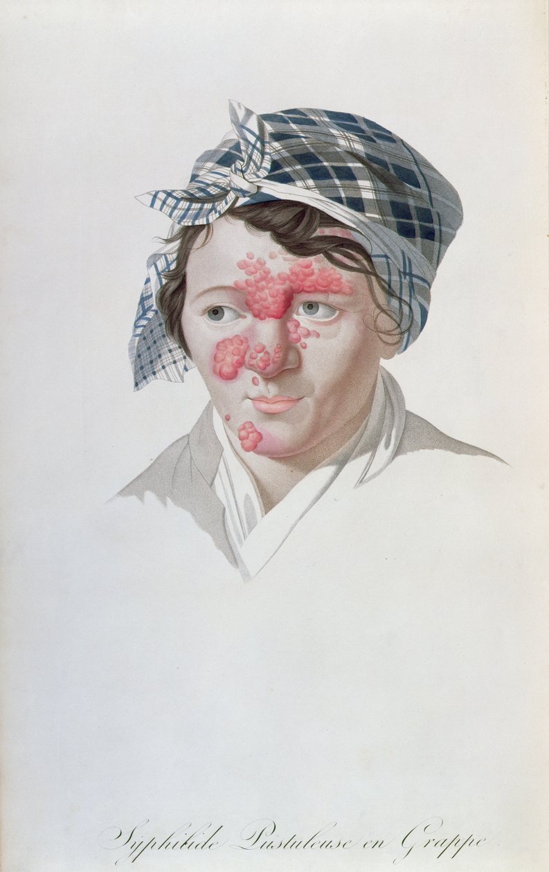Syfiliske klyngepustler, fra en bog af Baron Jean Louis Alibert (1768-1837) 1838 af Salvadore Tresca