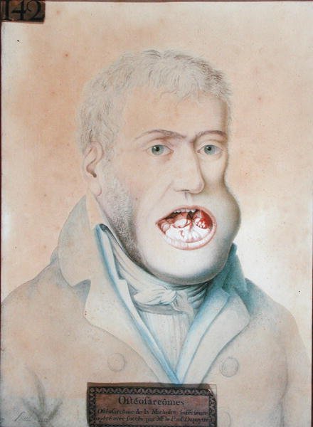 Osteosarkom i underkæben, opereret med succes af Guillaume Dupuytren (1777-1835) (blyant på papir) af School French