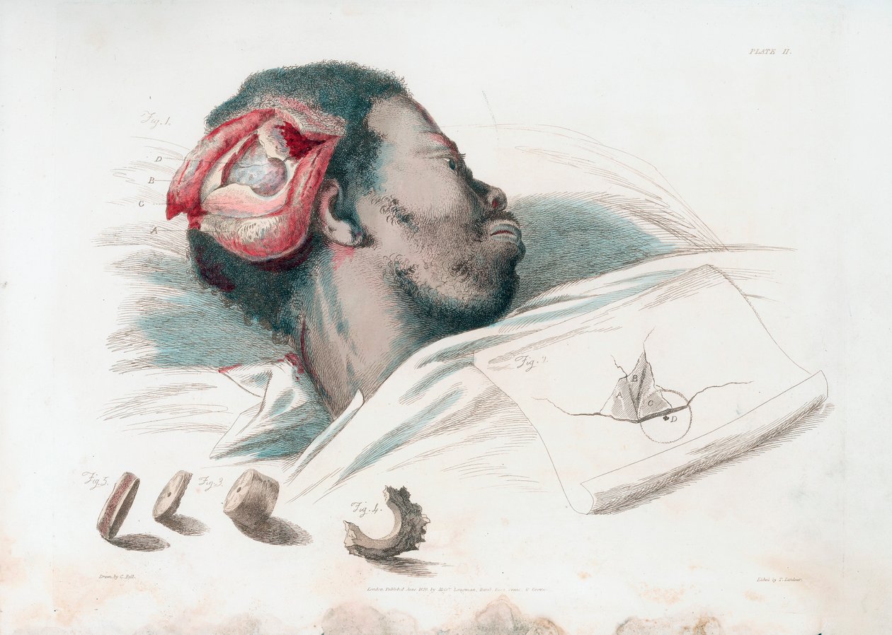 Visning af sår i kraniet efter trephination og fjernelse af knust knoglestykke nederst til venstre, 1821 af Thomas Landseer