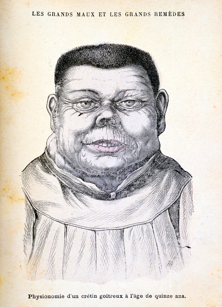 Cretin 15 år, c1890 af Unbekannt