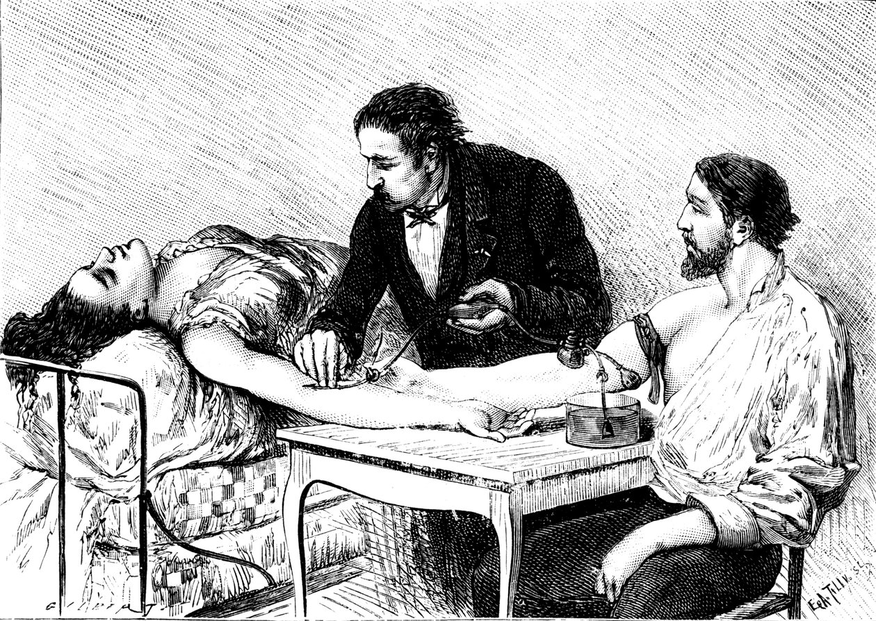 Dr. Roussell fra Genève gav en kvinde en direkte blodtransfusion fra en frivillig, 1882 af Unbekannt