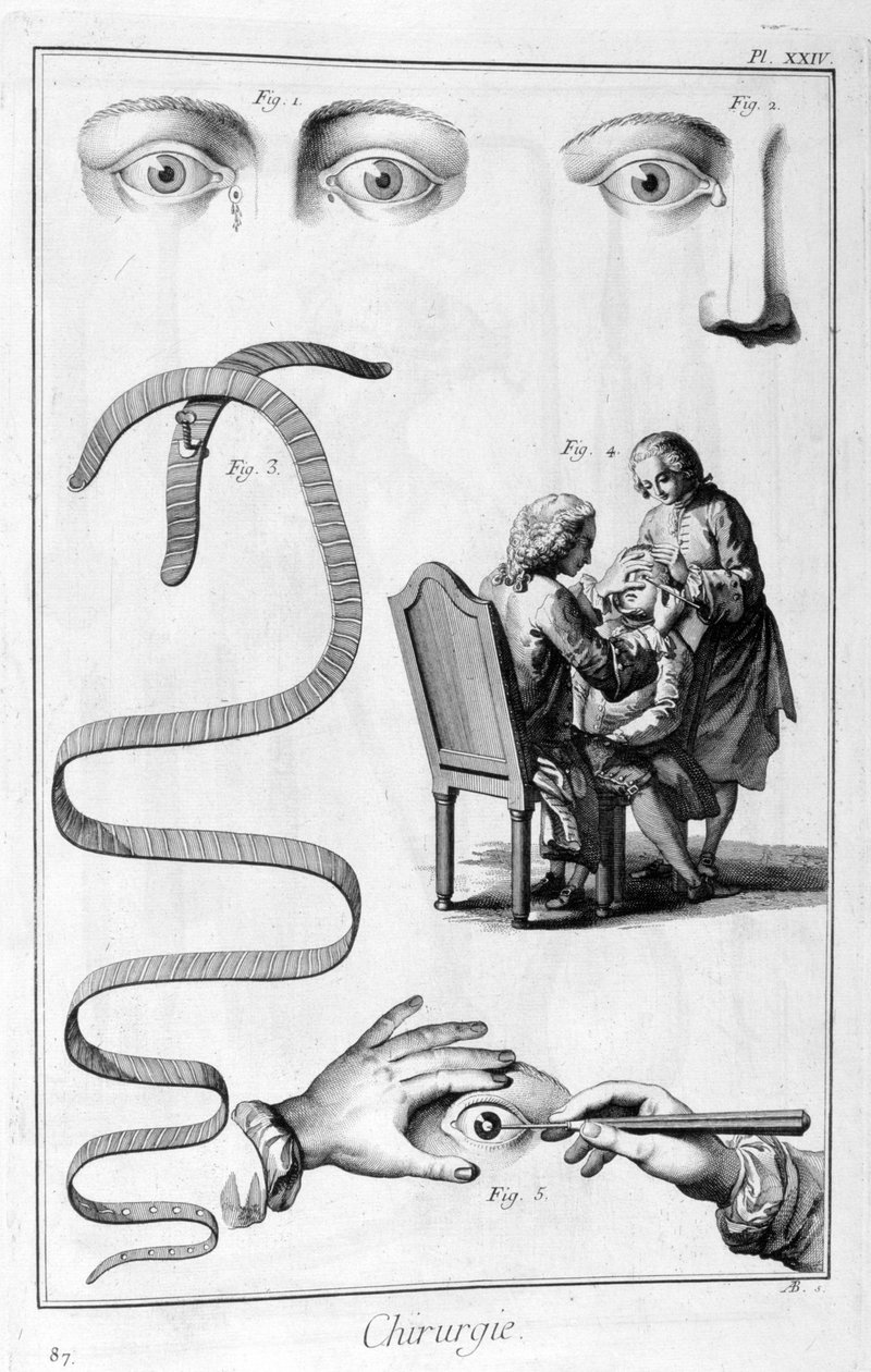 Øjenkirurgi, 1751-1777 af Unbekannt
