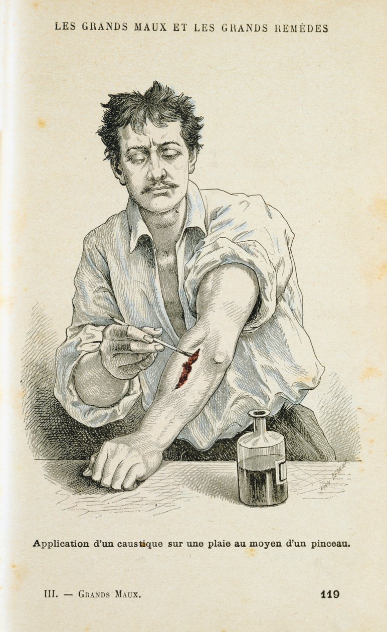 Maling af et sår med en antiseptisk opløsning, c1890 af Unbekannt