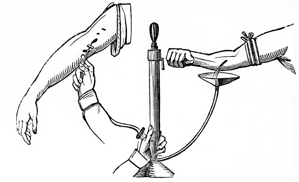 Person-til-person blodtransfusion, 1833 af Unbekannt