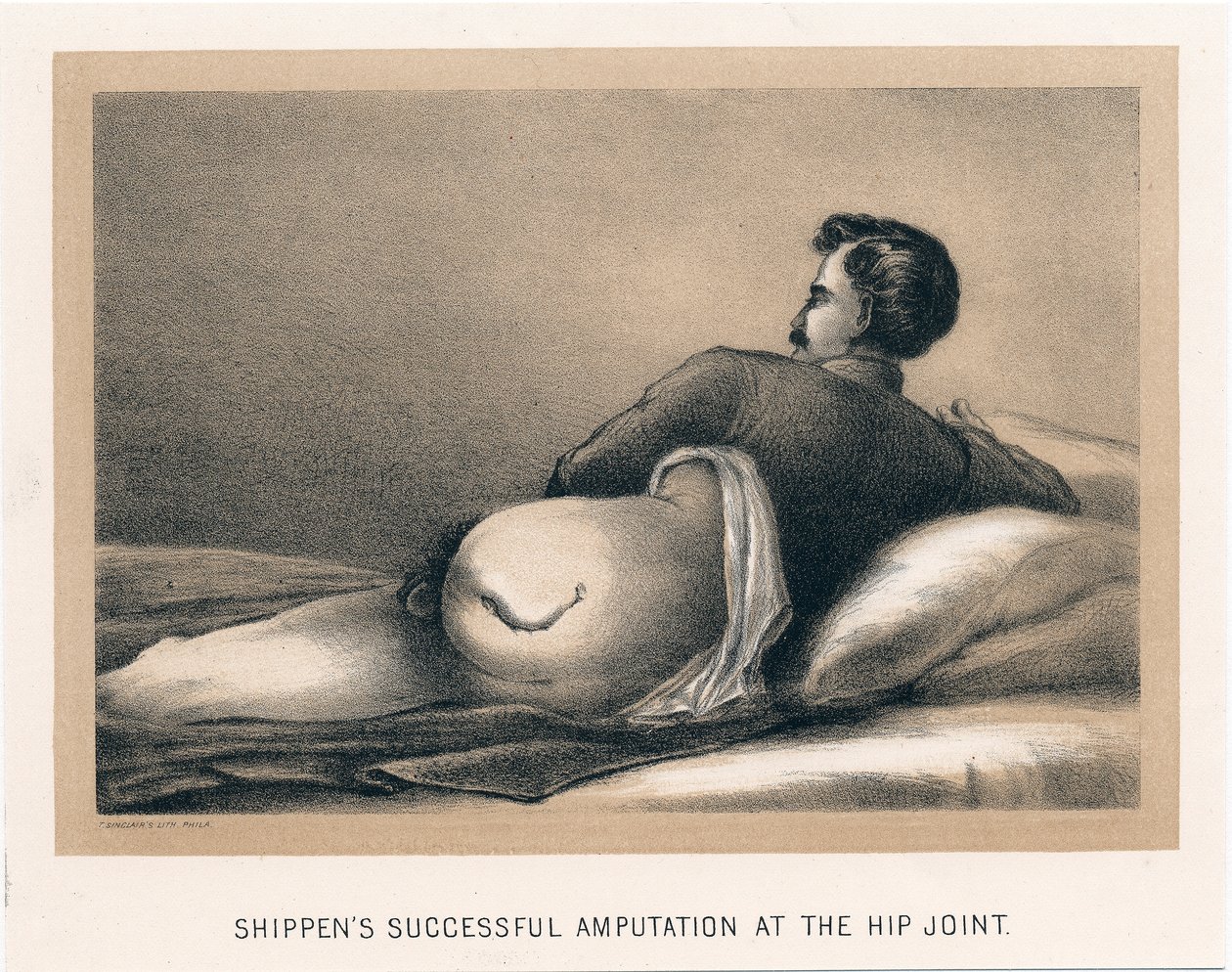 Sender succesfuld amputation ved hofteleddet, amerikansk borgerkrig, 1865 af Unbekannt