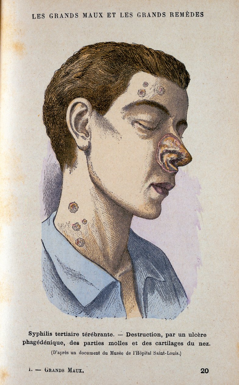 Symptomer på den tertiære fase af syfilis, c1800-tallet af Unbekannt
