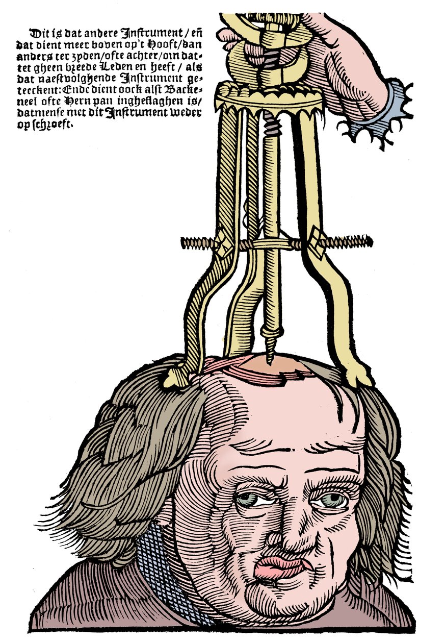 Trephination, 1593 af Unbekannt