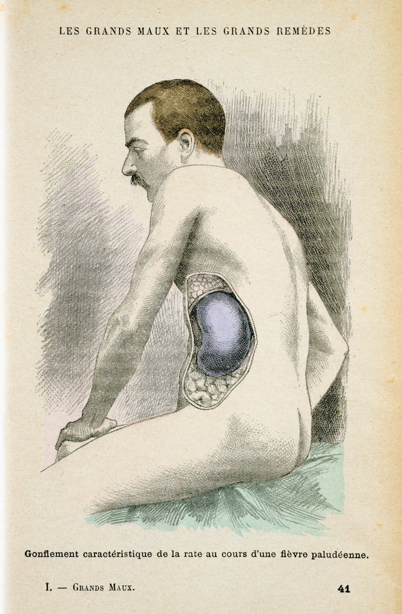 Typisk forstørret milt hos en malariapatient, c1890 af Unbekannt