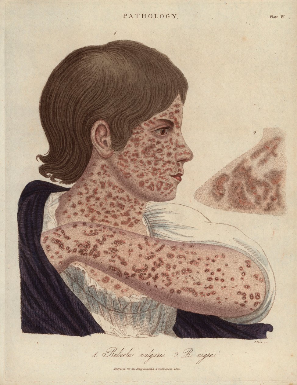 Measles and Rubeole - Litografi af John Pass, udgivet i "Encyclopedia Londinensis" af John Wilkes, edition J.Adlard, London af Unbekannter Künstler