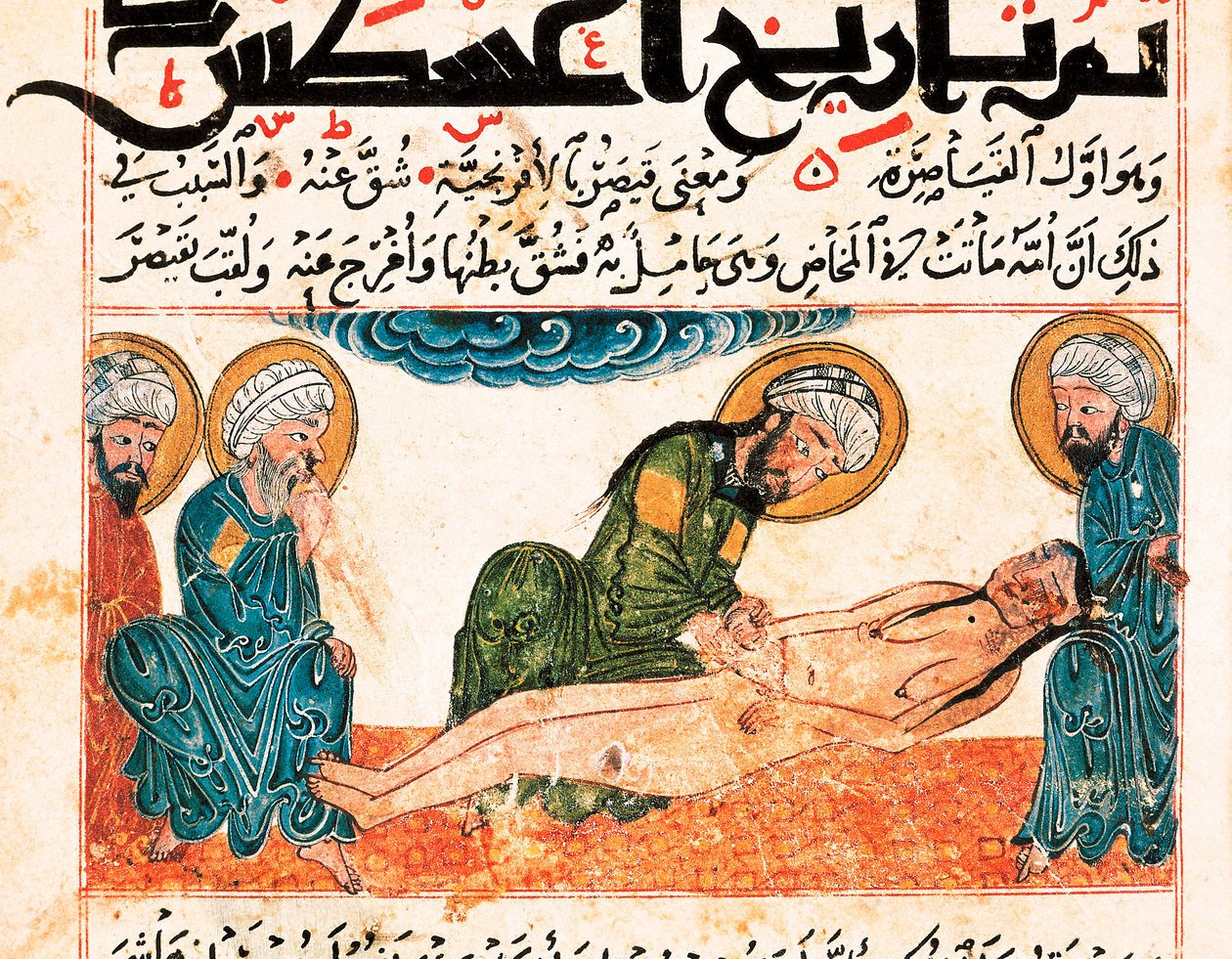 Repræsentation af kejsersnit. Miniature taget fra et manuskript af medicin af Abu Raihan Al-Biruni (eller Alberuni) (973-1048), persisk intellektuel og videnskabsmand, folio 161. af Unbekannt