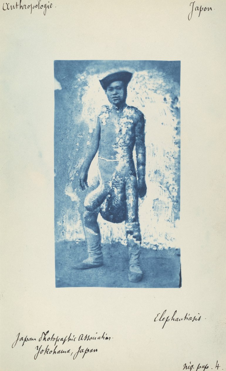 Elefantiasis af Unknown 19th Century